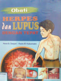 Image of Obati Herpes dan Lupus dengan Tepat